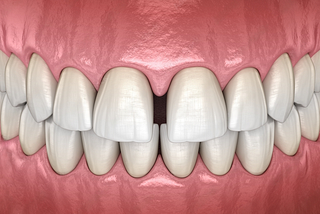3D illustration of diastema, showing a noticeable gap between the two front central incisor teeth, representing a common dental condition.