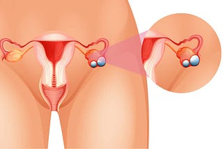 What Are the Risk Factors for Developing Ovarian Cancer?