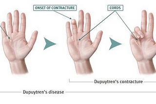 Diagram showing three palms at progressive stages of Dupuytren’s Disease. 1st palm shows palm nodules. 2nd palm shows slight contraction of ring finger. 3rd palm shows ring and small finger contracted into palm.