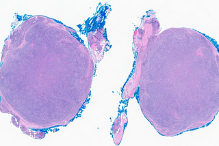 Angiolymphoid Hyperplasia with Eosinophilia