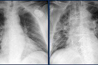 Covid 19 Chest X Ray Classification using Transfer Learning and KNN Classifier