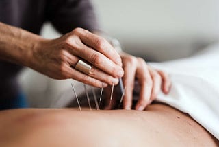 Acupuncture Treatment in St. Pete