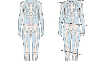 Balancing Steps: Understanding and Managing Leg Length Discrepancy