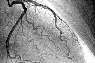 KNOW MORE ABOUT PICTURISING YOUR HEART — ANGIOGRAPHY