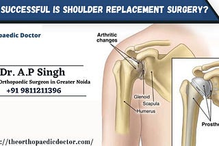 How Successful is Shoulder Replacement Surgery?