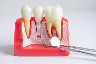 Benefits of Root Canal Treatment — Pain-Free Procedure