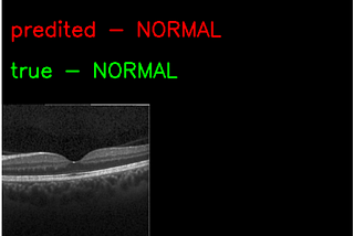 Detecting Retina Damage from OCT-Retinal Images