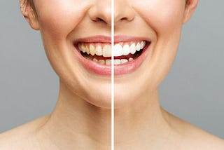 How Long Does Teeth Whitening by a Specialist Last?