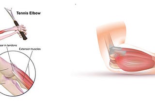 Causes and Prevention of Tennis Elbow