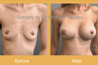 Breast Surgery: Basic Things To Know