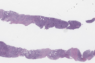 NPM1-Mutated Myeloid Sarcoma