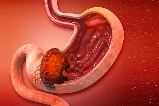 What is the Survival Rate for Stomach (Gastric) Cancer?