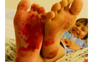 Young child giggling showing the soles of his feet covered in red nail polish.