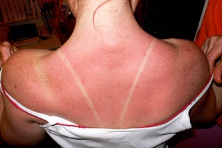 How To Get Sunburned Like A Pro