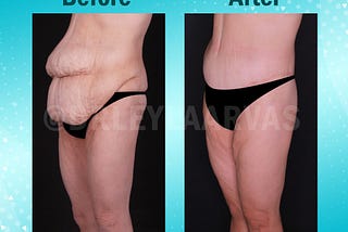 Tummy tuck abdominoplasty before and after