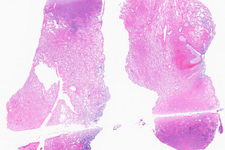 EBV+ DLBCL with LYG Features