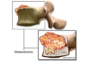 Obat Osteosarcoma AMPUH Juga Aman Dikonsumsi Tanpa Efek Samping
