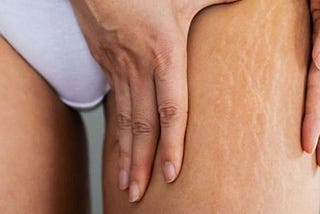 4 Excellent tips for you eliminate
white and red stretch marks red