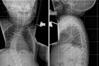 Two side-by-side MRI images of the author’s 15 month old son. His spine is severely curved and his head tilted.