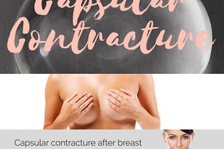 Capsular Contracture Treatment in Florida: A Comprehensive Guide