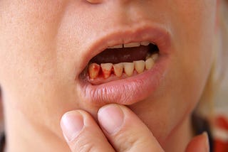 Here’s Exactly What You Need to Do if Your Gums Bleed