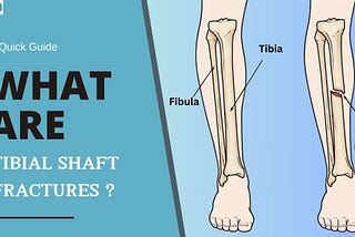 What Are Tibial Shaft Fractures? A Quick Guide