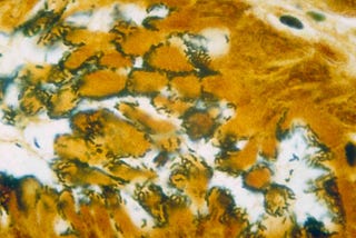 Microscope image of human epithelial cells (yellow) being swarmed by S-shaped bacteria (silver)
