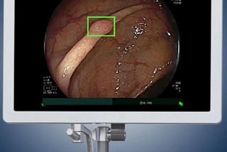 FDA Approves First AI Tool for Detecting Colorectal Polyps