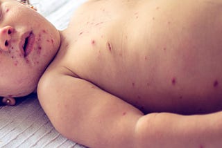 Understanding and Protecting Against the Rising Measles Outbreak in the U.S.