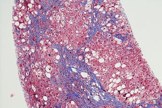 The Nobel Prize Is a Reminder of Hepatitis C’s Dark History