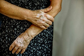 A close up of a woman’s arms and hands with vitiligo.