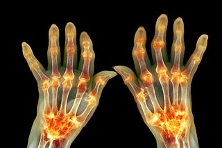 The Complex Riddles of Rheumatoid Arthritis