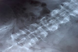 A Teenager’s Guide to Spinal Fusion