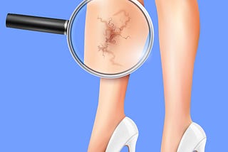 Are You At Risk of Getting Varicose Veins?