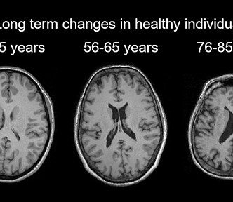 Brain changes over the lifespan.