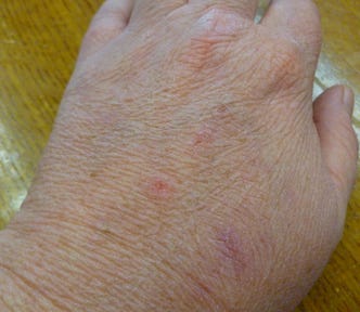 A close-up of a person’s hand shows the skin details clearly, and there are several red marks or blemishes visible on the back of the hand. The skin texture is wrinkled, and the photograph captures various skin tones and lines, suggesting a mature age for the individual.