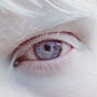 Albino_eye