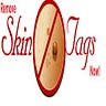 Remove Skin Tags Now