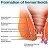 hemorrhoidstreatmentok