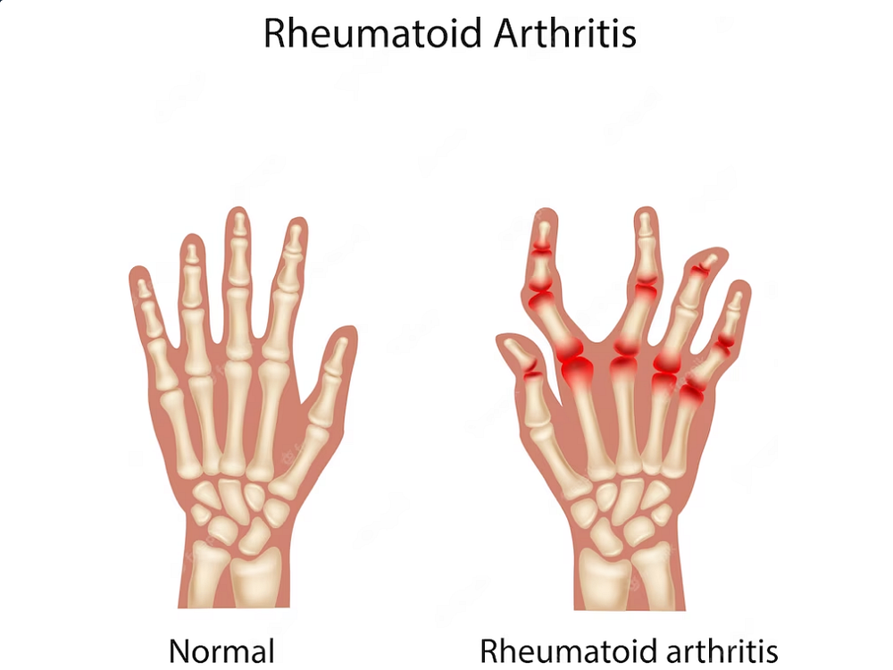 The Rheumatoid Arthritis Diet Food to Eat and Avoid by Sonam Mehta