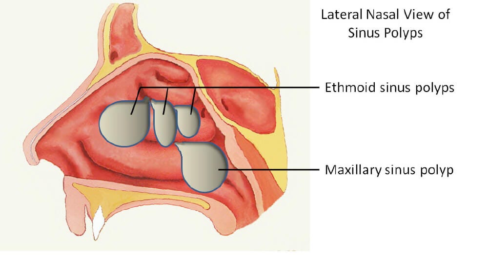 Bilateral 2024 nasal polyps