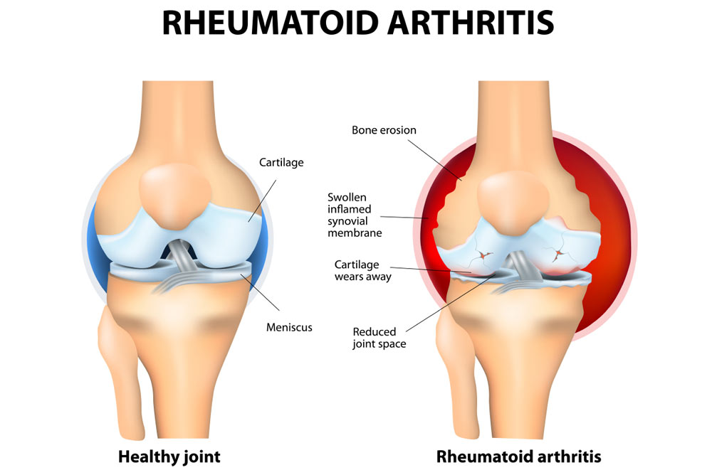 Healthy Joint Compared to RA Joint (Source: Chris Bailey Orthopaedics)