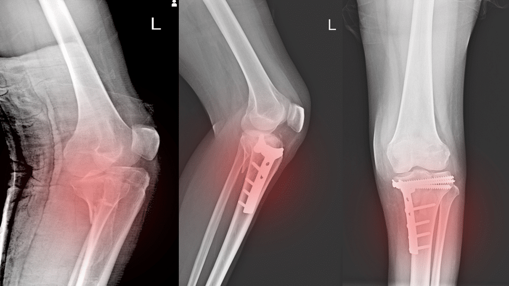 Growth Plate Injury Treatment London: Helping Young Bones Heal Safely