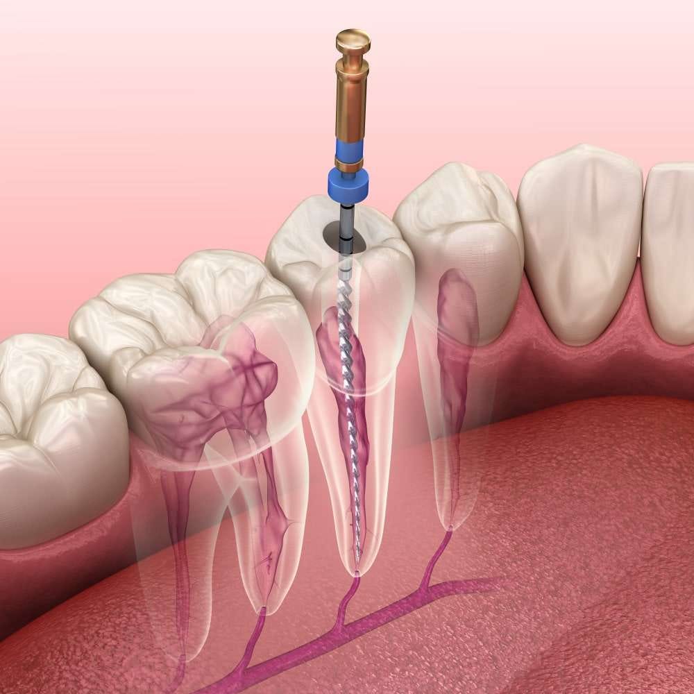 Searching for reliable root canal treatment in Bangalore?