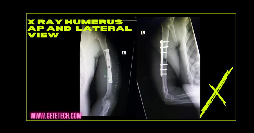 humerus x ray