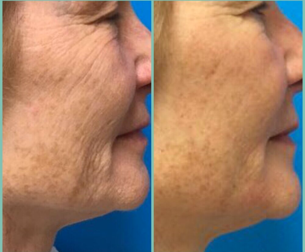 How Does the Halo Laser for Removal of Acne Scars, Discoloration, and Small Wrinkles Work