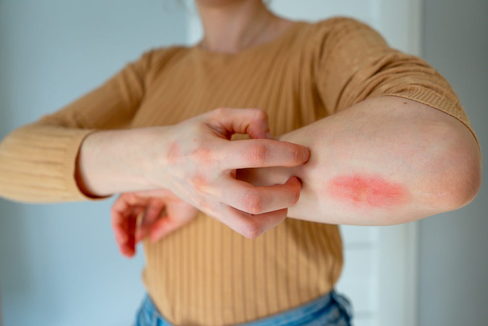 Relief for Skin Rashes and Itching Understanding Treatment Options by