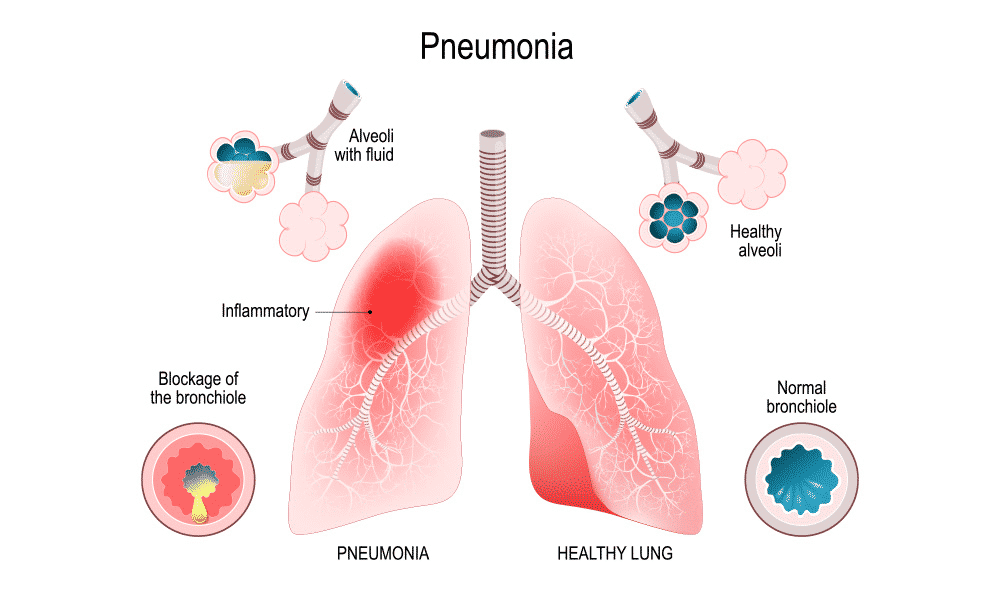 Bronchial Pneumonia bronchial-pneumonia