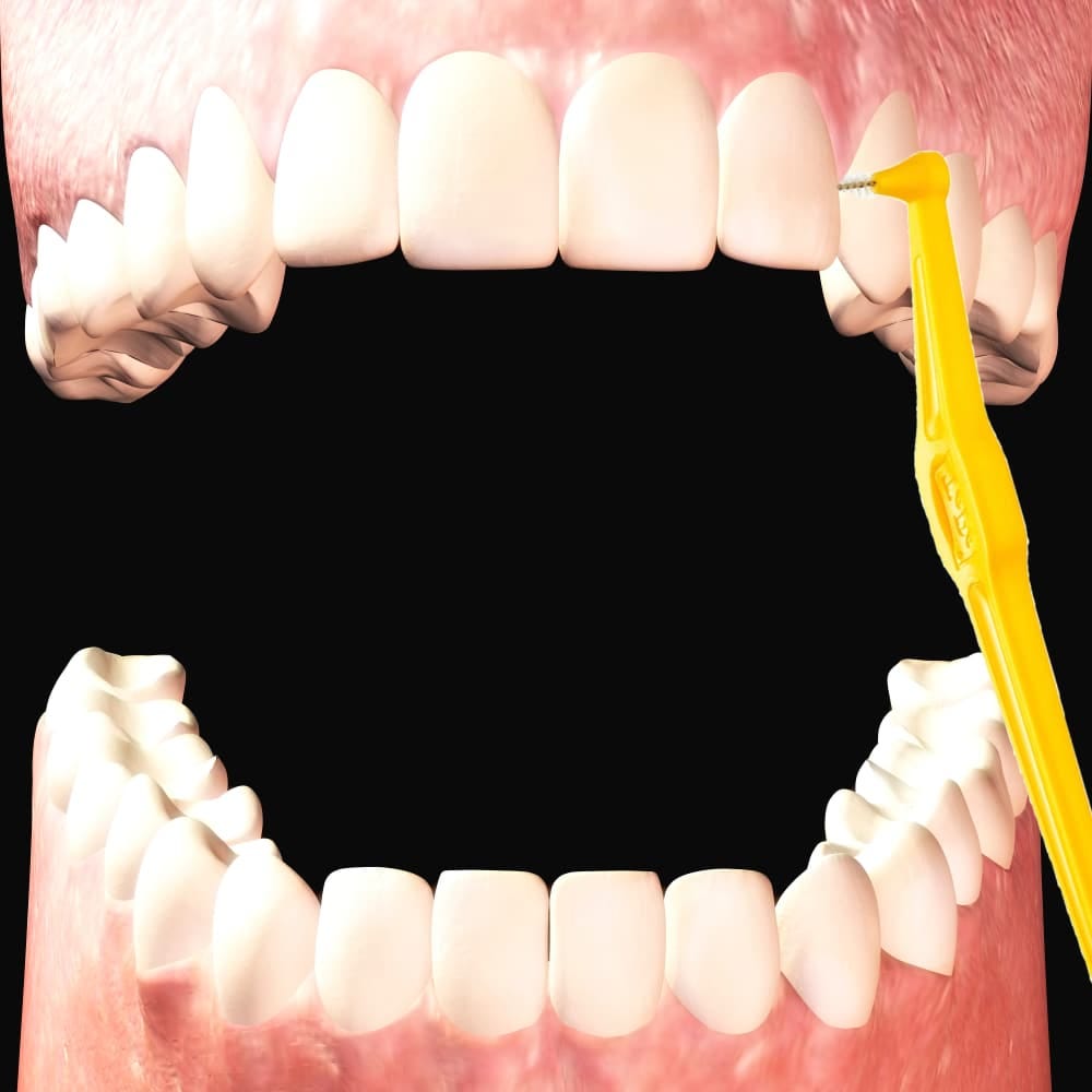 What are Interdental Brushes?. Excellent oral hygiene should be a part