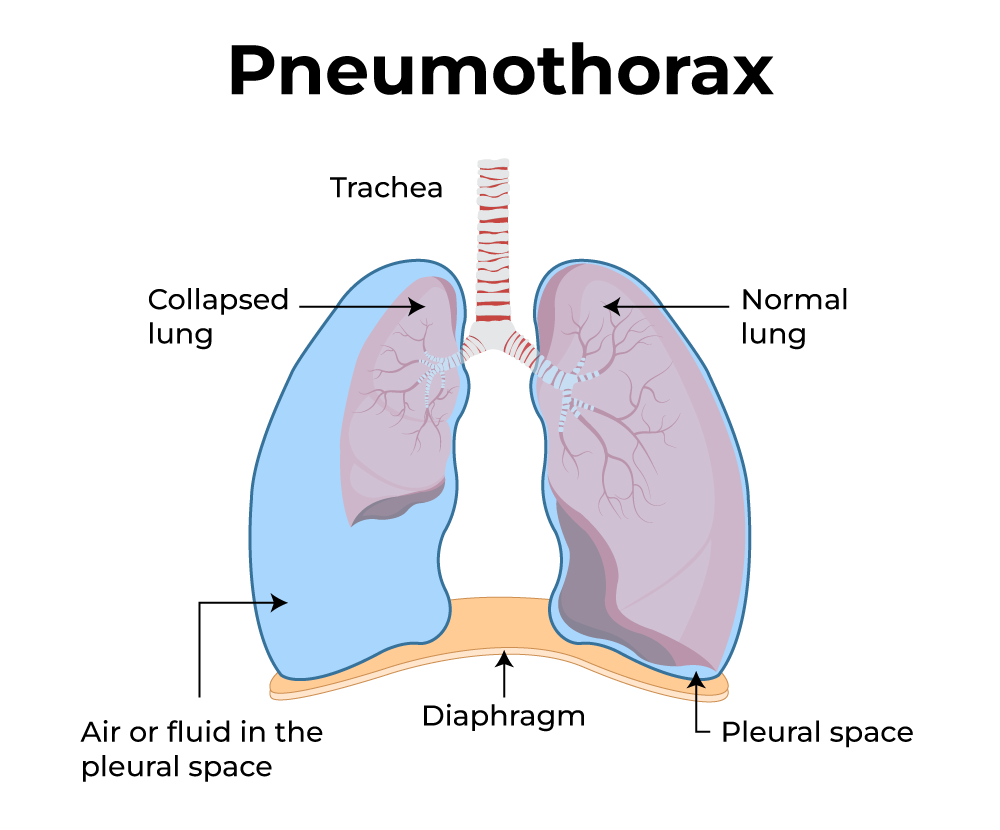 Pneumothorax Pneumothorax-Causes-Symptoms-Diagnosis-Homeopathic-Allopathic-Treatment-Dr-Qaisar-Ahmed-Risalpur